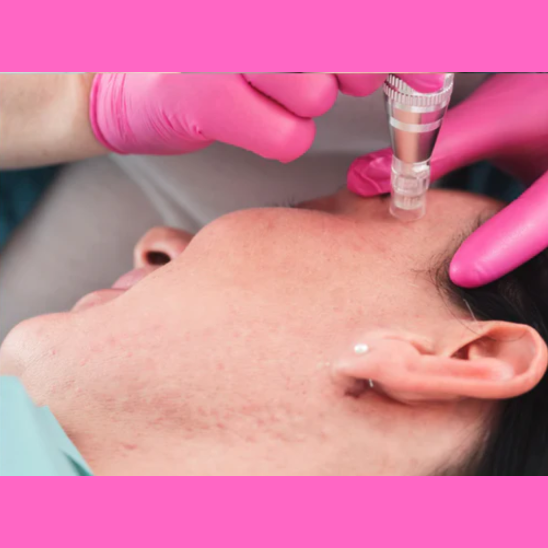 Micro Needling Online Certification - imagebykelz