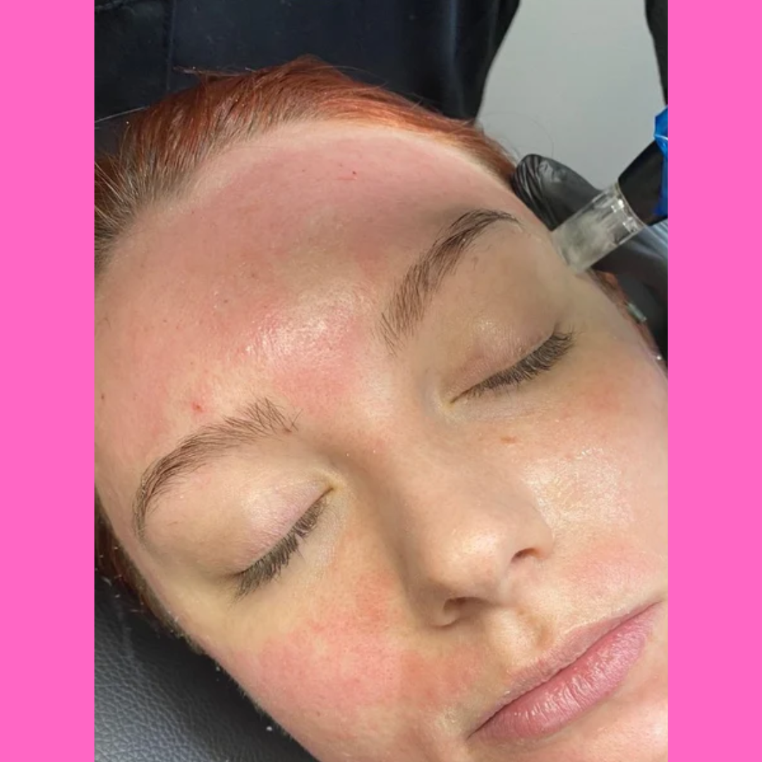 Micro Needling PRO KIT - imagebykelz