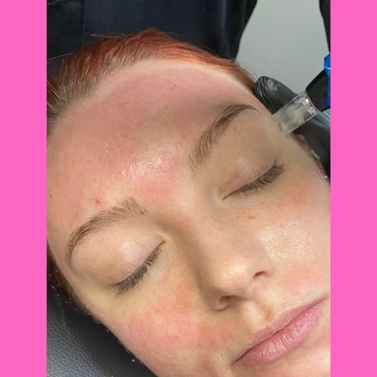 Micro Needling PRO KIT - imagebykelz