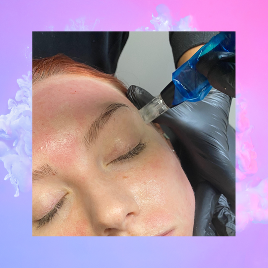 Microneedling - imagebykelz