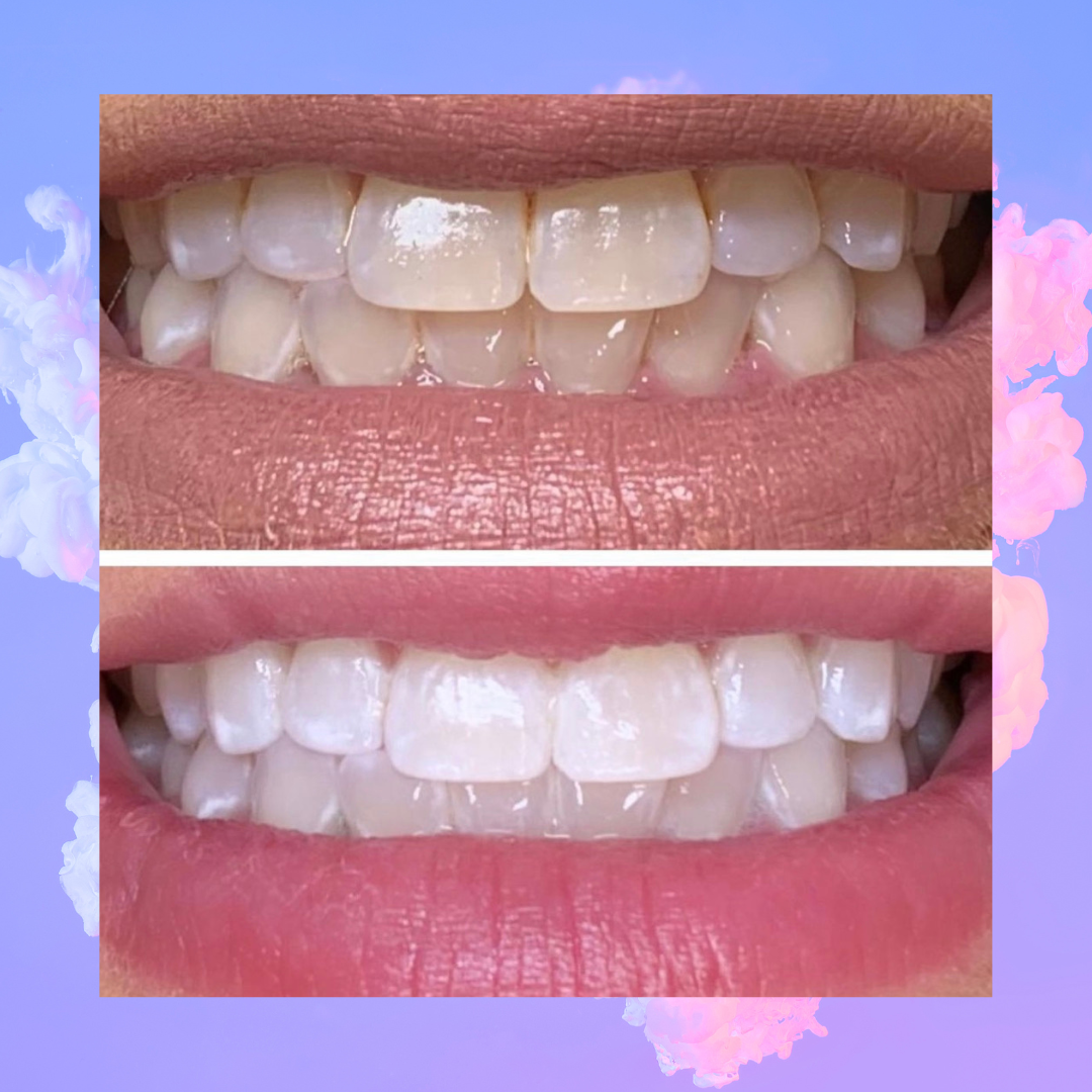 Teeth Whitening - imagebykelz