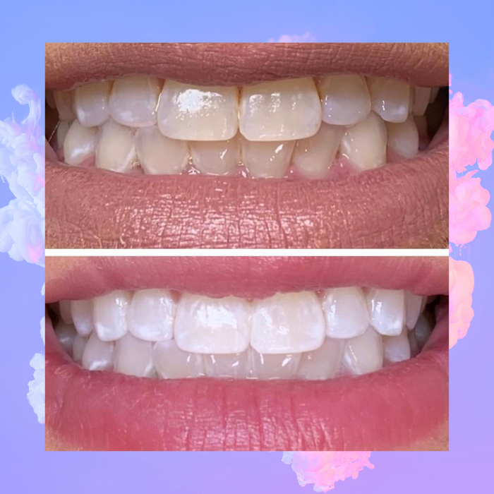 Teeth Whitening - imagebykelz