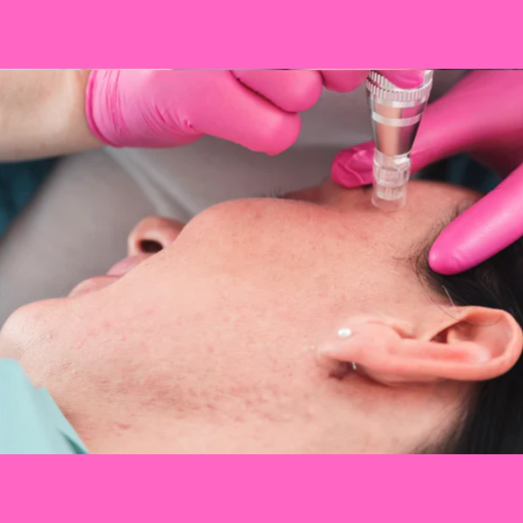 Micro Needling Online Certification