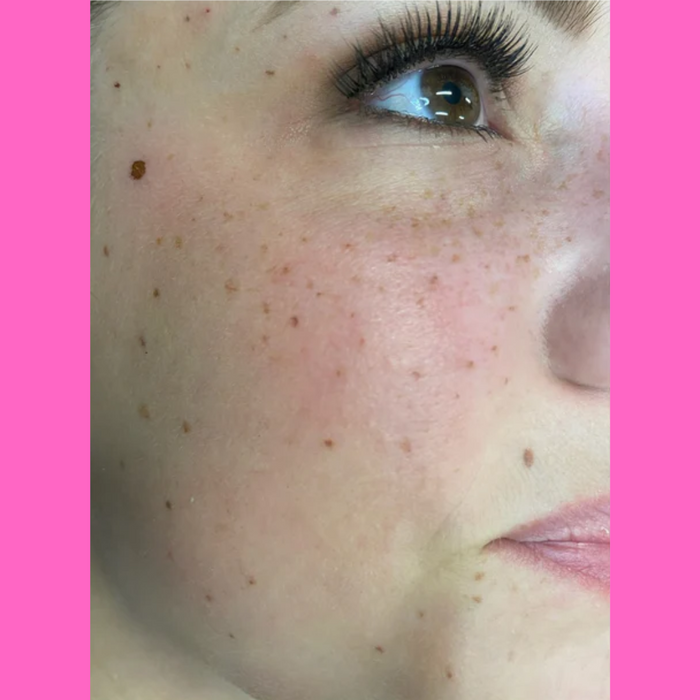 PMU Freckles & Beauty Marks Training