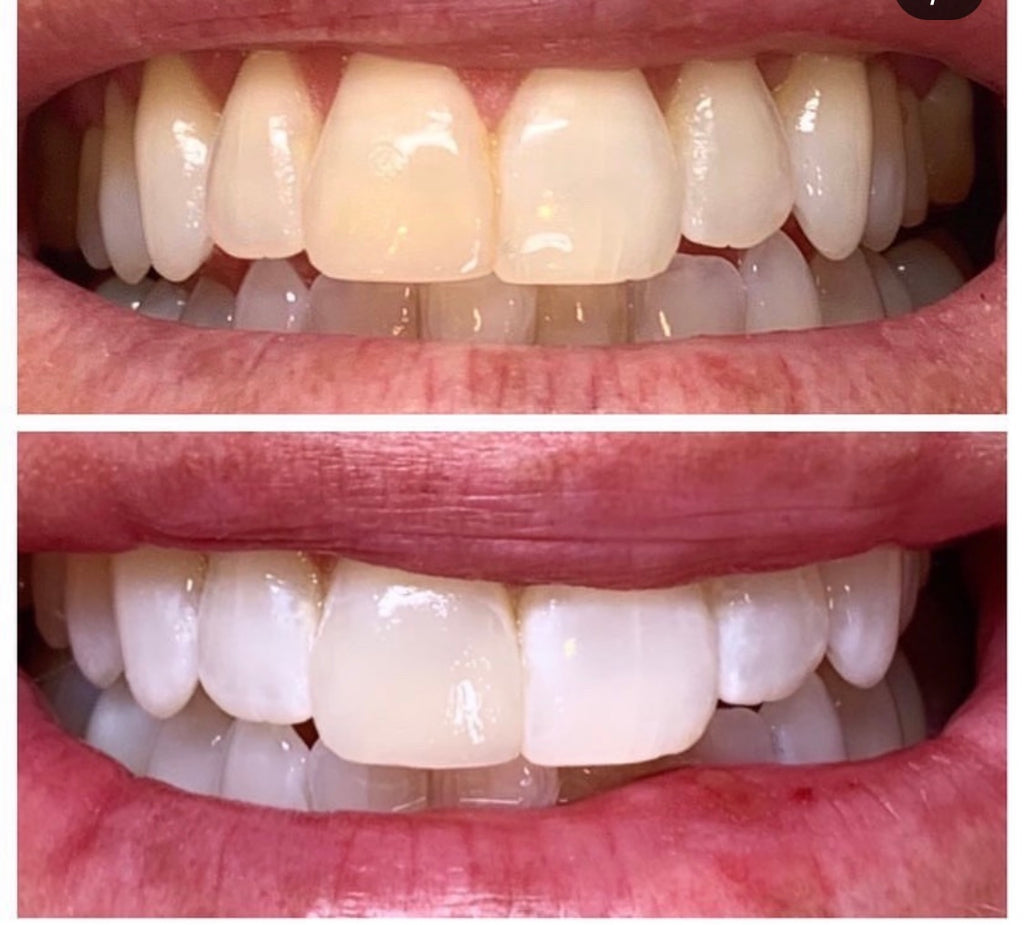 Teeth Whitening Kit + FREE Training - imagebykelz
