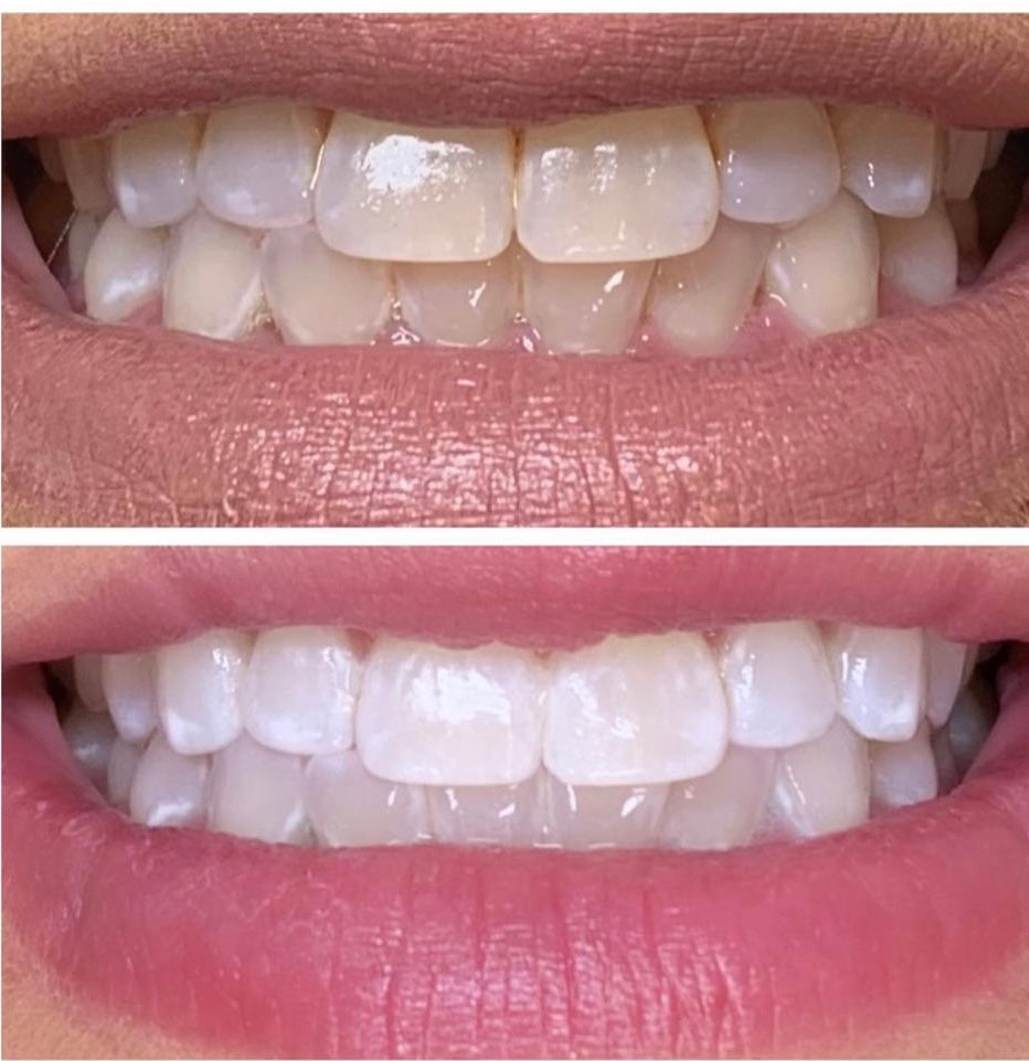 Teeth Whitening Kit + FREE Training - imagebykelz